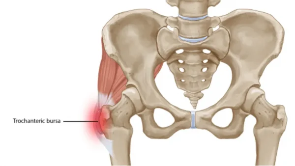 Anatomical diagram of the hip showing the trochanteric bursa and surrounding tendons